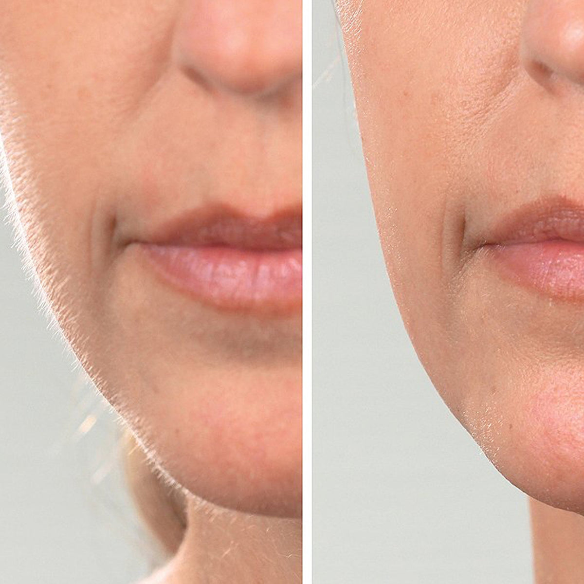 DermaQueen Vibra-Sonic® Depilación + Exfoliante Dermaplane